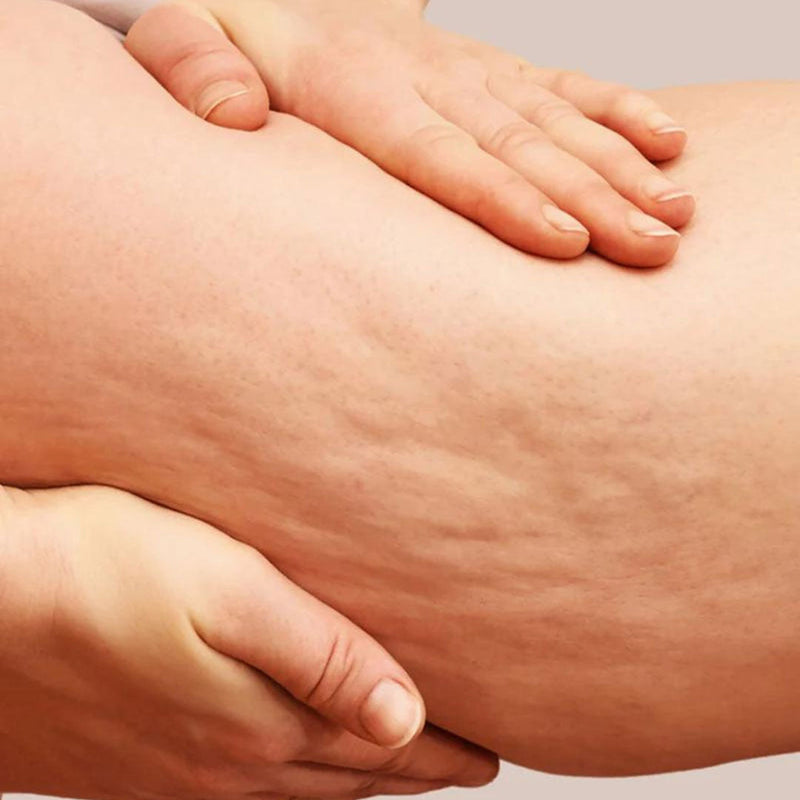 Kit para estrias/pele flácida - Bumbum, Coxas, Barriga